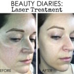 Beauty Diaries: Laser Treatment